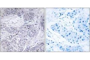 Immunohistochemistry analysis of paraffin-embedded human breast carcinoma tissue, using CEBPG Antibody. (CEBPG anticorps  (AA 31-80))