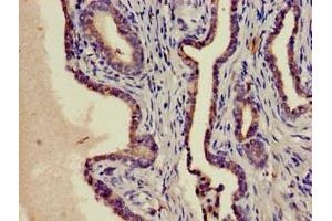 Immunohistochemistry of paraffin-embedded human prostate cancer using ABIN7169141 at dilution of 1:100 (PIM1 anticorps  (AA 25-86))