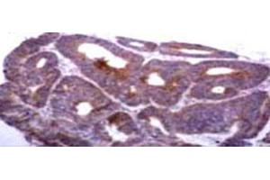 Immunohistochemical staining of TIMP1 on human colon carcinoma tissue with TIMP1 monoclonal antibody, clone 2A5 . (TIMP1 anticorps)
