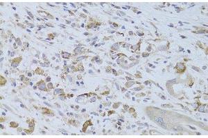 Immunohistochemistry of paraffin-embedded Human breast cancer using IGF2 Polyclonal Antibody at dilution of 1:100 (40x lens). (IGF2 anticorps)