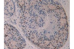 Detection of 5-LO in Human Prostate cancer Tissue using Polyclonal Antibody to 5-Lipoxygenase (5-LO) (ALOX5 anticorps  (AA 461-671))