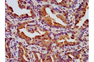 IHC image of ABIN7161158 diluted at 1:500 and staining in paraffin-embedded human lung cancer performed on a Leica BondTM system. (NPHP4 anticorps  (AA 397-543))