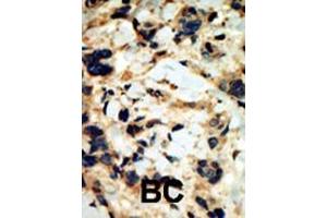 Formalin-fixed and paraffin-embedded human cancer tissue reacted with the primary antibody, which was peroxidase-conjugated to the secondary antibody, followed by DAB staining.