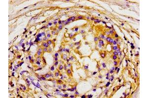 Immunohistochemistry of paraffin-embedded human breast cancer using ABIN7150072 at dilution of 1:100 (DLG2 anticorps  (AA 310-420))