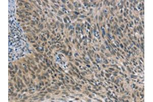 The image on the left is immunohistochemistry of paraffin-embedded Human cervical cancer tissue using ABIN7190689(FOXF1 Antibody) at dilution 1/25, on the right is treated with synthetic peptide.