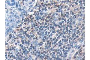 Detection of DOK3 in Human Skin cancer Tissue using Polyclonal Antibody to Docking Protein 3 (DOK3)