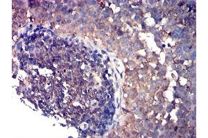 Immunohistochemical analysis of paraffin-embedded cervical cancer tissues using CD80 mouse mAb with DAB staining. (CD80 anticorps  (AA 35-288))