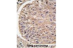 Formalin-fixed and paraffin-embedded human lung carcinoma tissue reacted with IKK beta antibody (ABIN1882097 and ABIN2842182) , which was peroxidase-conjugated to the secondary antibody, followed by DAB staining. (IKBKB anticorps)