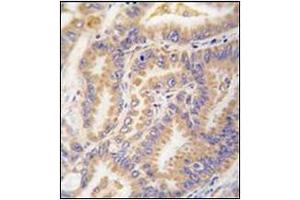 Formalin-fixed and paraffin-embedded human lung carcinoma tissue reacted with Autophagy APG12L Antibody (N-term), which was peroxidase-conjugated to the secondary antibody, followed by DAB staining. (ATG12 anticorps  (N-Term))