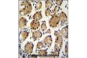 FAT10 Antibody (C-term) (ABIN655263 and ABIN2837857) immunohistochemistry analysis in formalin fixed and paraffin embedded human stomach carcinoma followed by peroxidase conjugation of the secondary antibody and DAB staining. (UBD anticorps  (C-Term))