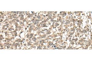 Immunohistochemistry of paraffin-embedded Human esophagus cancer tissue using PHF21A Polyclonal Antibody at dilution of 1:50(x200)