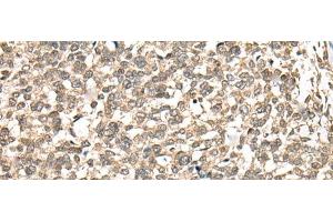 Immunohistochemistry of paraffin-embedded Human esophagus cancer tissue using PHF21A Polyclonal Antibody at dilution of 1:50(x200) (PHF21A anticorps)
