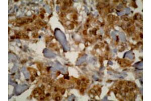 Immunohistochemistry staining of human prostate cancer tissue using CYP3A7 monoclonal antibody, clone F19 P2 H2 . (CYP3A7 anticorps  (C-Term))