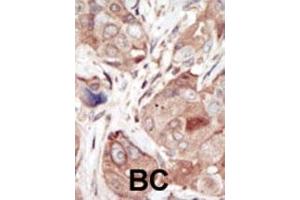 Formalin-fixed and paraffin-embedded human cancer tissue reacted with the primary antibody, which was peroxidase-conjugated to the secondary antibody, followed by DAB staining.