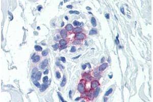 Human Breast (formalin-fixed, paraffin-embedded) stained with PRLR antibody ABIN351557 at 5 ug/ml followed by biotinylated goat anti-rabbit IgG secondary antibody ABIN481713, alkaline phosphatase-streptavidin and chromogen. (Prolactin Receptor anticorps)