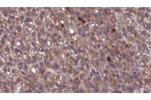 ABIN6276752 at 1/100 staining Human liver cancer tissue by IHC-P. (CHRM1 anticorps  (C-Term))