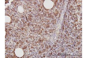 Immunoperoxidase of monoclonal antibody to CD58 on formalin-fixed paraffin-embedded human lymphoma tissue [antibody concentration 3 ug/ml]