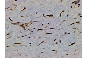 ABIN6267452 at 1/200 staining human bladder cancer tissue sections by IHC-P.