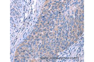 Immunohistochemistry of Human cervical cancer using ESPL1 Polyclonal Antibody at dilution of 1:40 (Separase anticorps)
