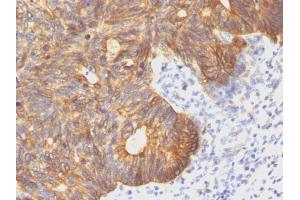 Formalin-fixed, paraffin-embedded human Colon Carcinoma stained with Cytokeratin 8 Mouse Monoclonal Antibody (C-43).