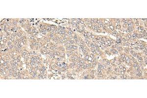 Immunohistochemistry of paraffin-embedded Human liver cancer tissue using C12orf40 Polyclonal Antibody at dilution of 1:50(x200) (C12orf40 anticorps)