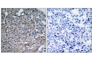 Immunohistochemical analysis of paraffin-embedded human breast carcinoma tissue using FAK (Ab-925) antibody (E021148). (FAK anticorps)