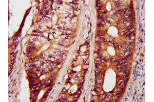 IHC image of ABIN7169132 diluted at 1:800 and staining in paraffin-embedded human colon cancer performed on a Leica BondTM system.