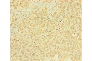 Immunohistochemistry of paraffin-embedded human ovarian cancer using ABIN7165146 at dilution of 1: 100 (BTG4 anticorps  (AA 1-206))