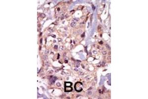Formalin-fixed and paraffin-embedded human cancer tissue reacted with the primary antibody, which was peroxidase-conjugated to the secondary antibody, followed by AEC staining.