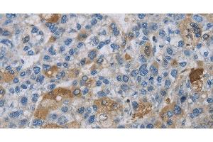 Immunohistochemistry of paraffin-embedded Human liver cancer using DNAJB4 Polyclonal Antibody at dilution of 1:50 (DNAJB4 anticorps)