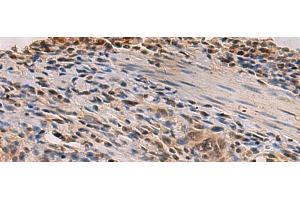 Immunohistochemistry of paraffin-embedded Human esophagus cancer tissue using PDS5B Polyclonal Antibody at dilution of 1:35(x200) (PDS5B anticorps)