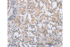 Immunohistochemistry of Human thyroid cancer using CDCP1 Polyclonal Antibody at dilution of 1:50 (CDCP1 anticorps)