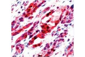 Formalin fixed paraffin embedded human angiosarcoma stained with Flk-1 antibody