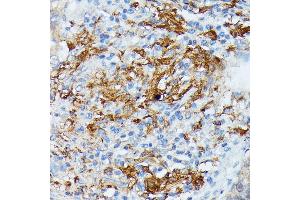 Immunohistochemistry of paraffin-embedded human lung cancer using RN antibody (ABIN7269987) at dilution of 1:100 (40x lens). (RNASE6 anticorps  (AA 1-150))
