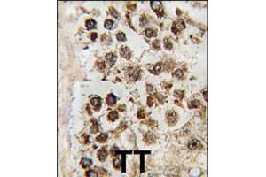 Formalin-fixed and paraffin-embedded human testis tissue reacted with MLLT10 antibody , which was peroxidase-conjugated to the secondary antibody, followed by DAB staining. (MLLT10 anticorps  (C-Term))