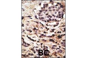 Formalin-fixed and paraffin-embedded human cancer tissue reacted with the primary antibody, which was peroxidase-conjugated to the secondary antibody, followed by DAB staining. (Beclin 1 anticorps  (AA 210-239))