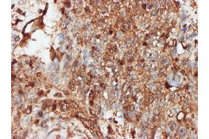 Immunoperoxidase of monoclonal antibody to PRKRA on formalin-fixed paraffin-embedded human squamous cell carcinoma.