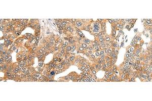 Immunohistochemistry of paraffin-embedded Human liver cancer tissue using HIPK2 Polyclonal Antibody at dilution of 1:40(x200) (HIPK2 anticorps)