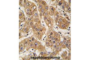 Formalin-fixed and paraffin-embedded human hepatocarcinomareacted with APOE polyclonal antibody , which was peroxidase-conjugated to the secondary antibody, followed by AEC staining. (APOE anticorps  (C-Term))