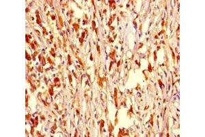 Immunohistochemistry of paraffin-embedded human melanoma using ABIN7162415 at dilution of 1:100 (NR1H2 anticorps  (AA 1-461))