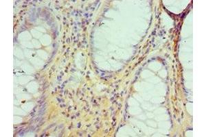 Immunohistochemistry of paraffin-embedded human colon cancer using ABIN7149566 at dilution of 1:100 (DIDO1 anticorps  (AA 1-300))