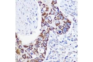 Immunohistochemistry of paraffin-embedded Human lung cancer using MTMR9 Rabbit pAb (ABIN6128253, ABIN6144163, ABIN6144164 and ABIN6217000) at dilution of 1:100 (40x lens).