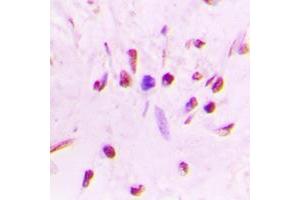 Immunohistochemical analysis of HSF1 (pS303) staining in human lung cancer formalin fixed paraffin embedded tissue section.