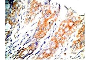 Human colon cancer tissue was stained by Rabbit Anti-GLP-1 (2-24) (Human) Antibody