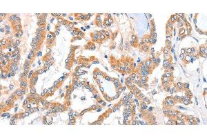 Immunohistochemistry of paraffin-embedded Human thyroid cancer tissue using ACSBG1 Polyclonal Antibody at dilution 1:40 (ACSBG1 anticorps)