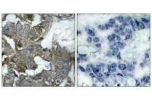 Immunohistochemistry analysis of paraffin-embedded human breast carcinoma tissue, using IkappaB-alpha (Ab-32/36) antibody.