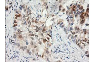 Immunohistochemical staining of paraffin-embedded Carcinoma of Human lung tissue using anti-HPGD mouse monoclonal antibody. (HPGD anticorps)