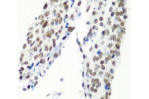 Immunohistochemistry of paraffin-embedded Human lung cancer using HTATSF1 Polyclonal Antibody at dilution of 1:100 (40x lens).