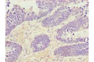 Immunohistochemistry of paraffin-embedded human ovarian cancer using ABIN7166396 at dilution of 1:100 (PADI3 anticorps  (AA 1-664))