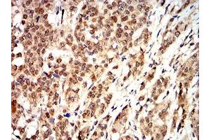 Immunohistochemical analysis of paraffin-embedded bladder cancer tissues using CCND1 mouse mAb with DAB staining.